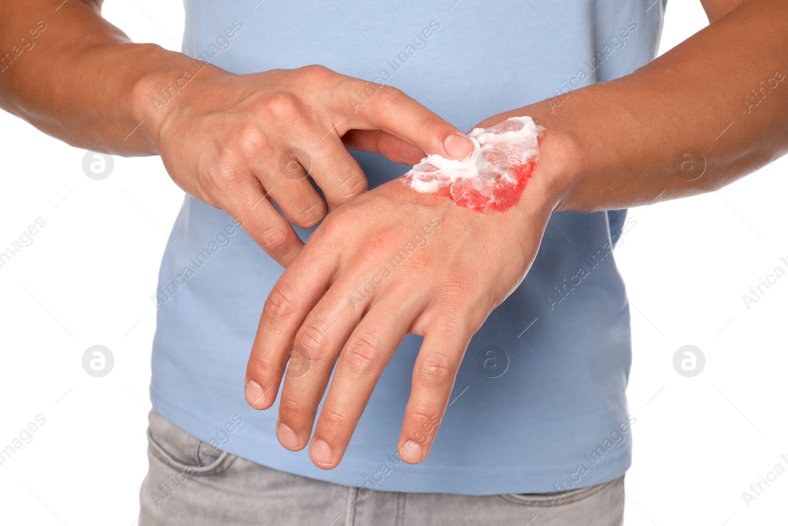 Photo of Man applying healing cream onto burned hand on white background, closeup
