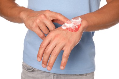 Photo of Man applying healing cream onto burned hand on white background, closeup