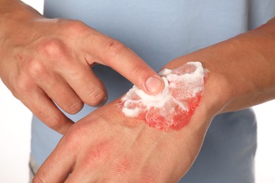Photo of Man applying healing cream onto burned hand on white background, closeup