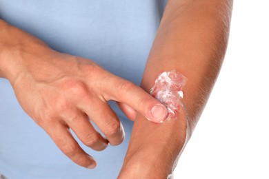 Photo of Man applying healing cream onto burned hand on white background, closeup