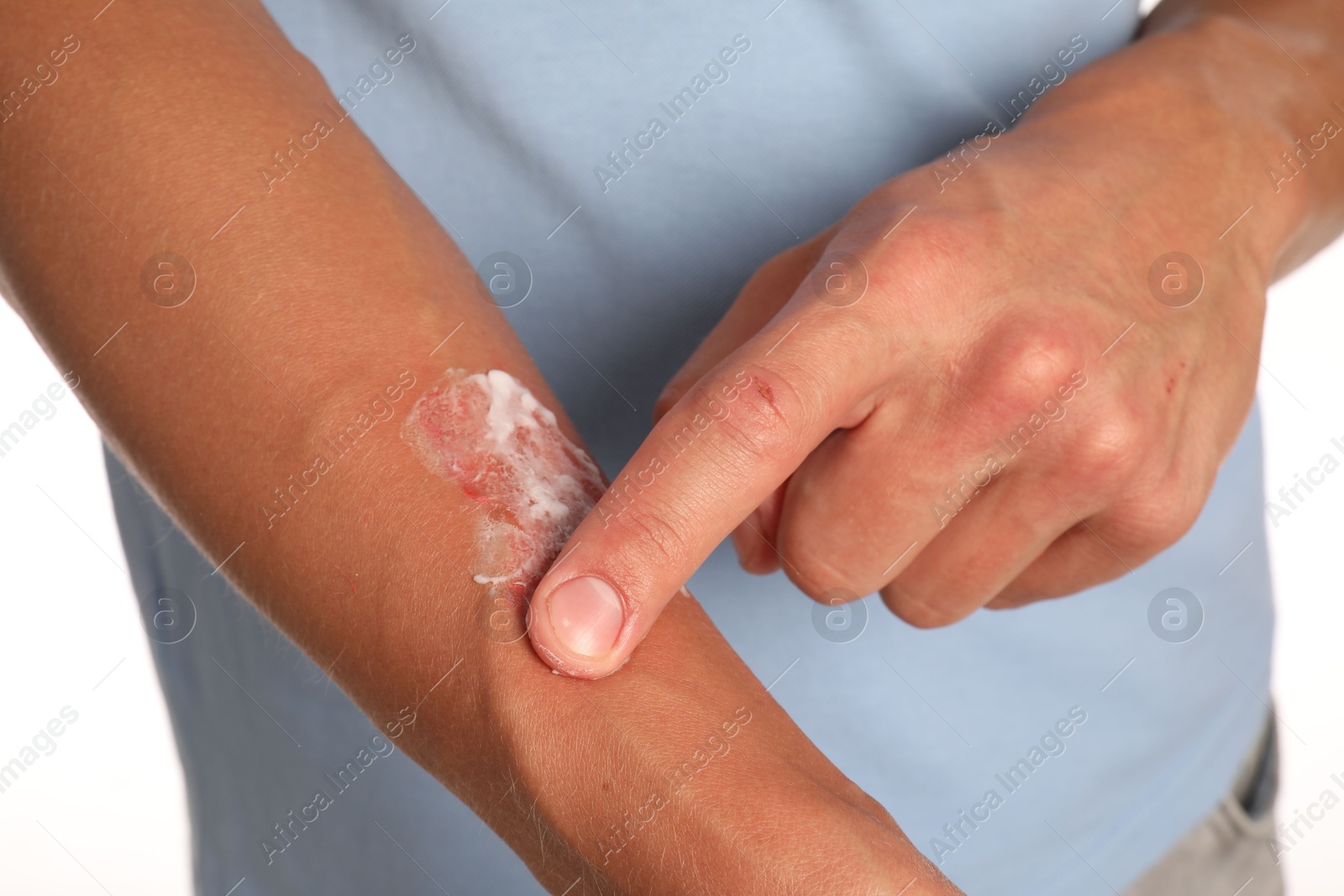Photo of Man applying healing cream onto burned hand on white background, closeup