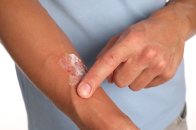 Photo of Man applying healing cream onto burned hand on white background, closeup