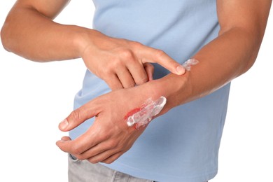 Photo of Man applying healing cream onto burned hand on white background, closeup