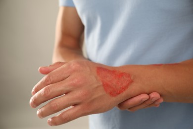 Photo of Man with burned hand on light grey background, closeup