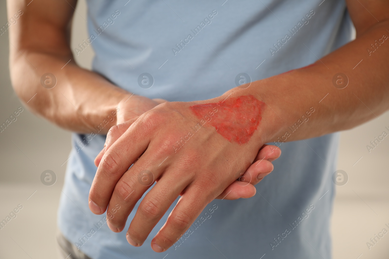 Photo of Man with burned hand on light grey background, closeup