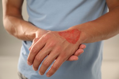 Photo of Man with burned hand on light grey background, closeup