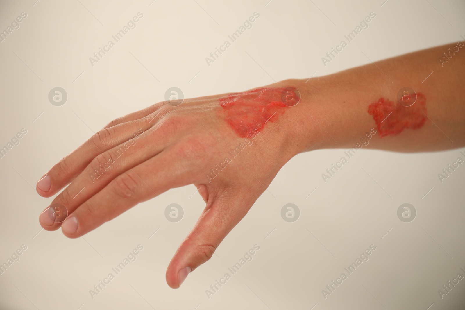 Photo of Man with burned hand on light grey background, closeup
