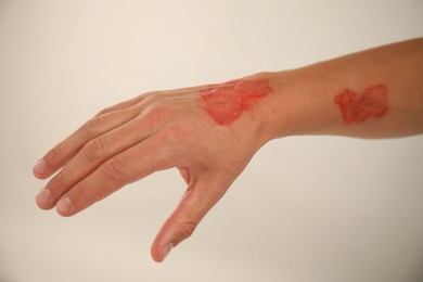 Photo of Man with burned hand on light grey background, closeup