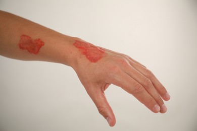 Photo of Man with burned hand on light grey background, closeup