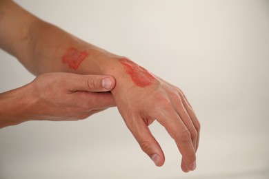 Photo of Man with burned hand on light grey background, closeup