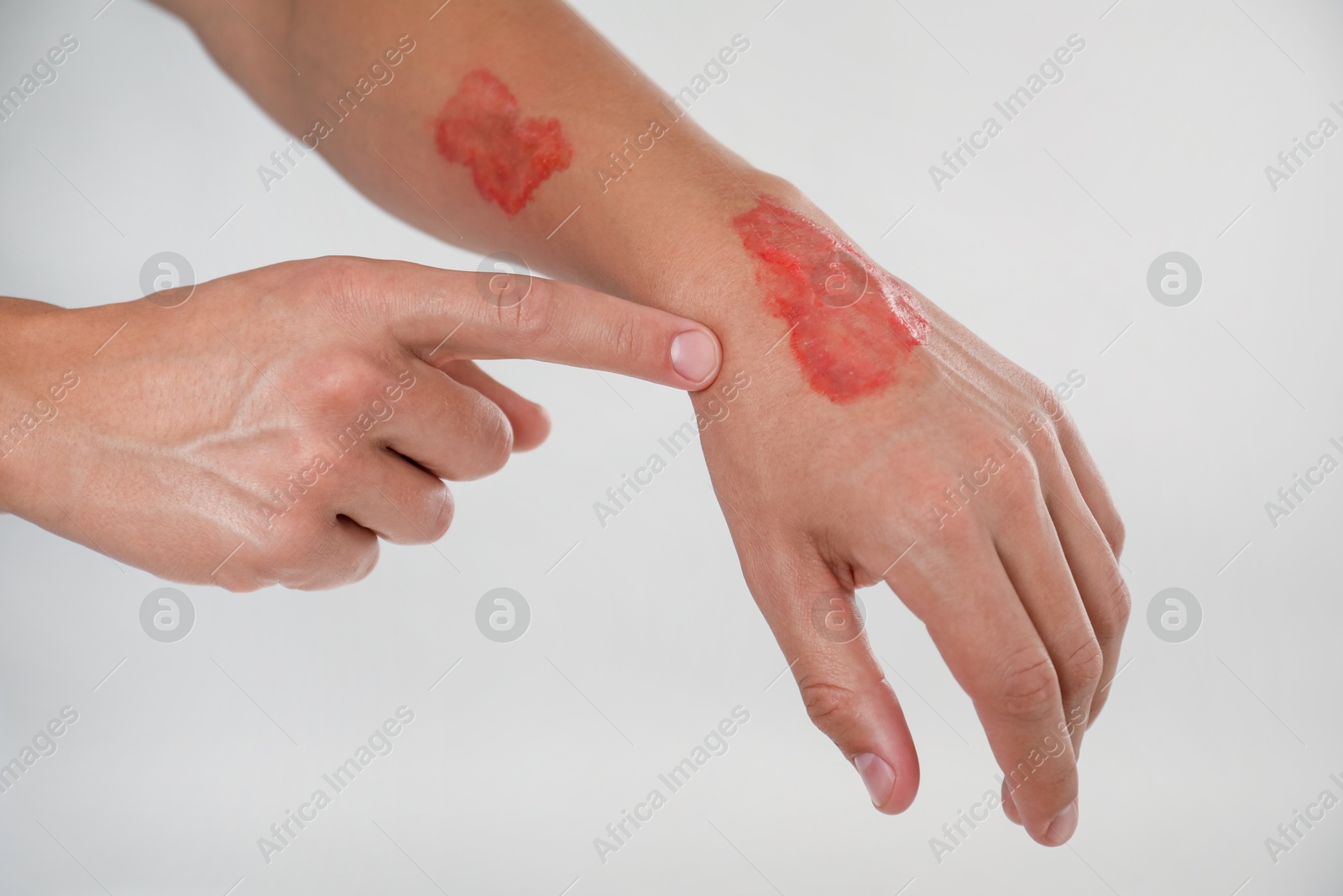 Photo of Man with burned hand on light grey background, closeup