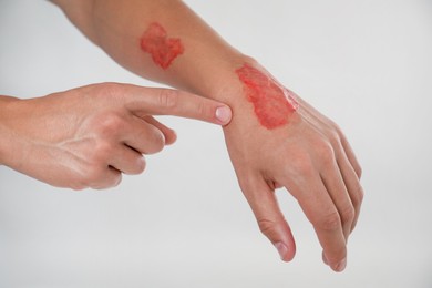 Photo of Man with burned hand on light grey background, closeup