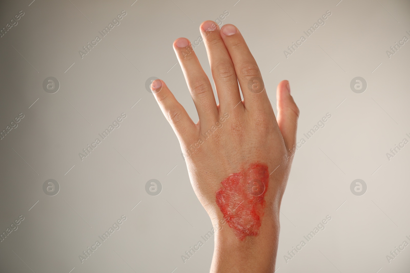 Photo of Man with burned hand on light grey background, closeup. Space for text