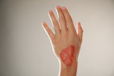 Photo of Man with burned hand on light grey background, closeup. Space for text
