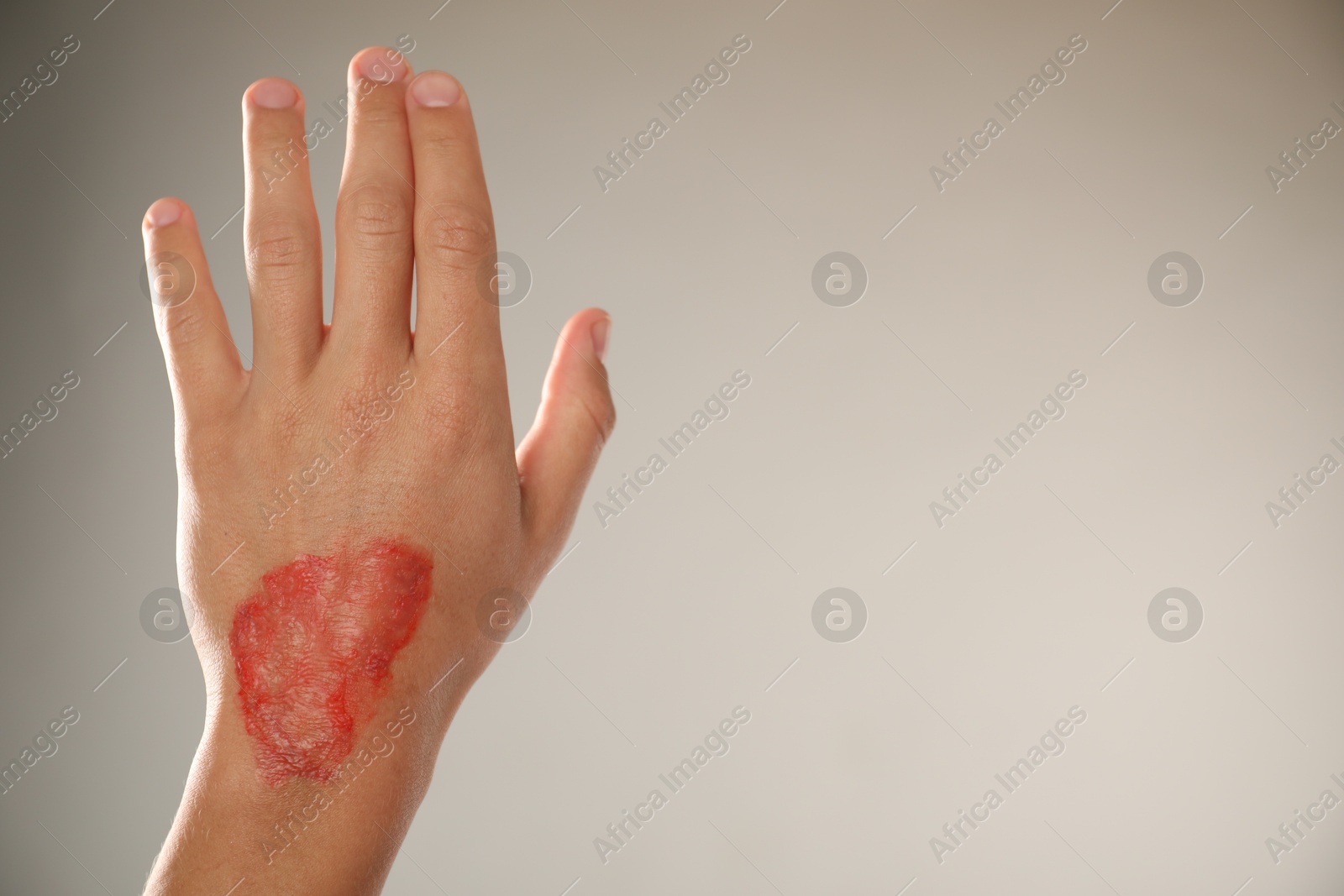 Man with burned hand on light grey background, closeup. Space for text Photo of Man with burned hand on light grey background, closeup. Space for text