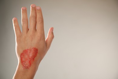 Photo of Man with burned hand on light grey background, closeup. Space for text