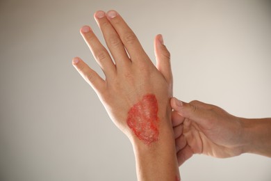 Photo of Man with burned hand on light grey background, closeup