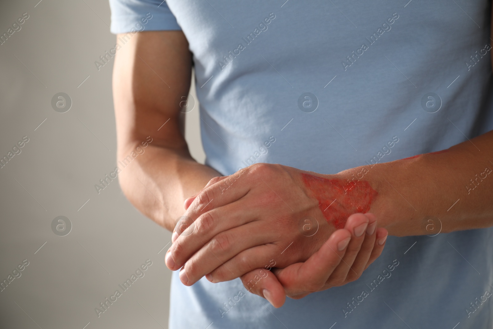 Photo of Man with burned hand on light grey background, closeup