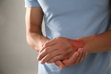 Photo of Man with burned hand on light grey background, closeup