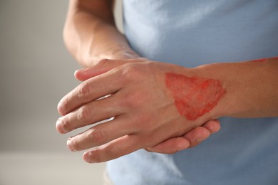 Photo of Man with burned hand on light grey background, closeup