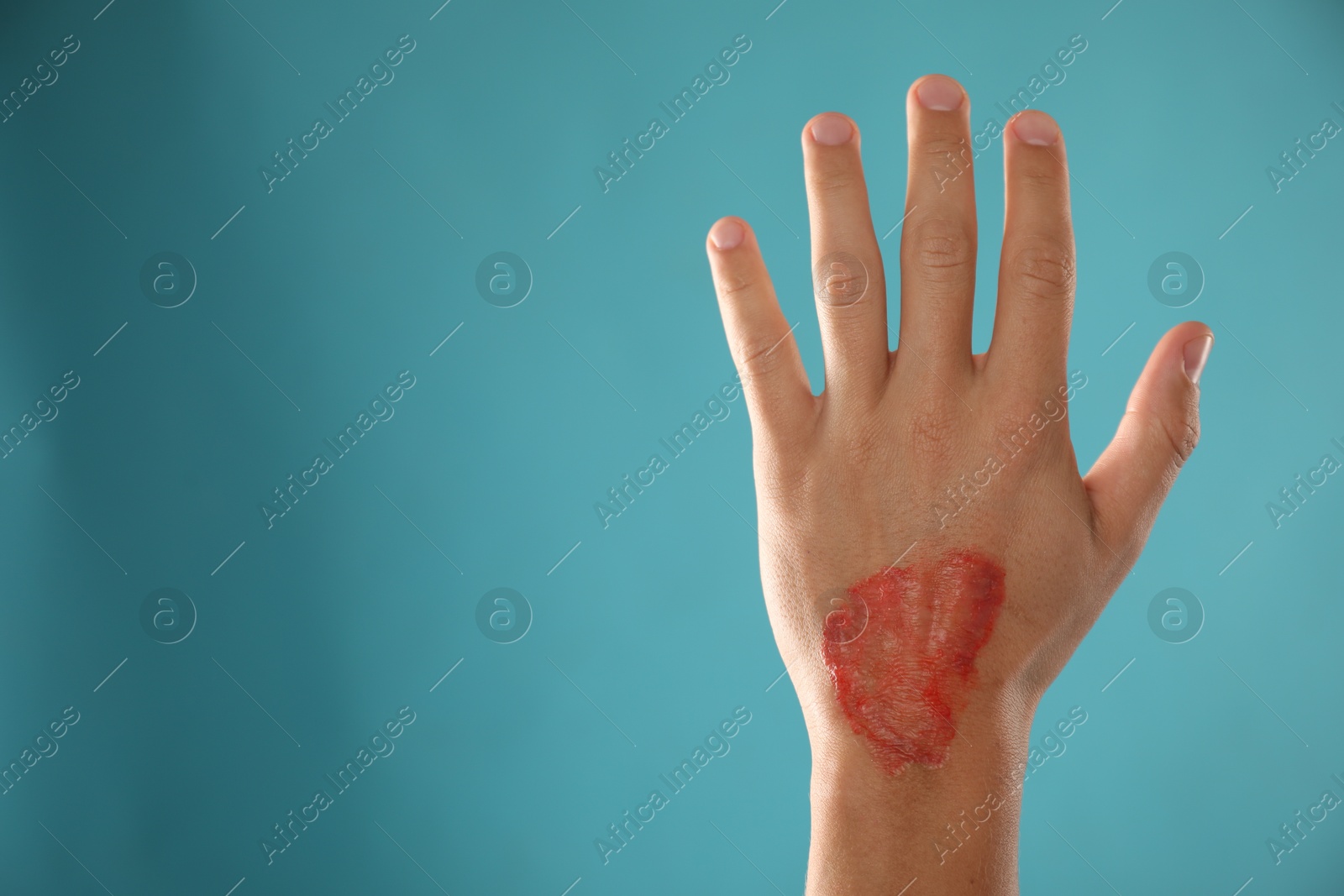 Photo of Man with burned hand on light blue background, closeup. Space for text