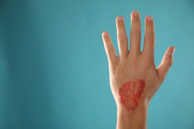 Photo of Man with burned hand on light blue background, closeup. Space for text