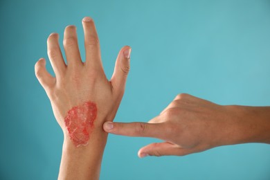 Photo of Man with burned hand on light blue background, closeup