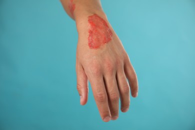 Photo of Man with burned hand on light blue background, closeup