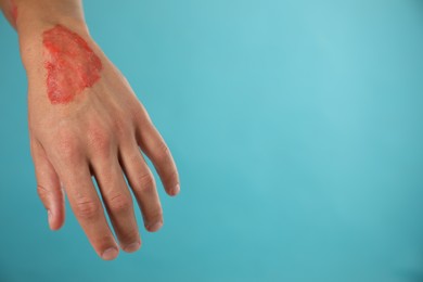 Photo of Man with burned hand on light blue background, closeup. Space for text