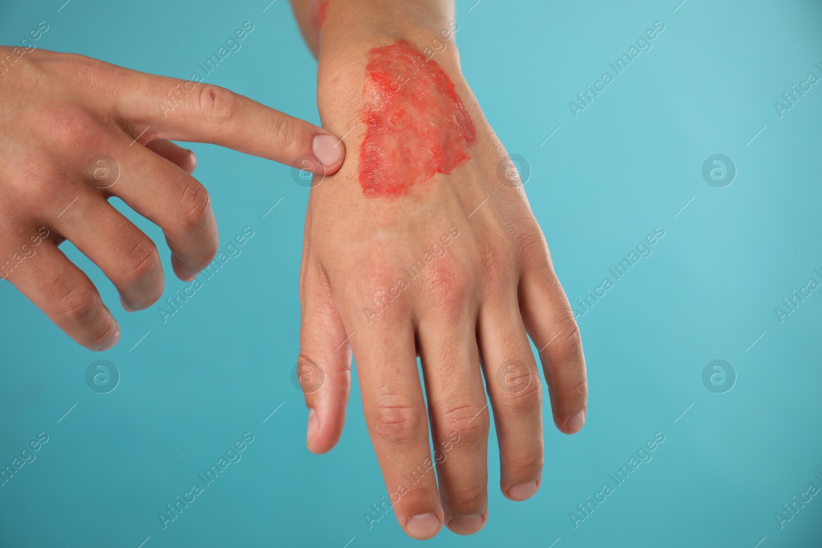 Photo of Man with burned hand on light blue background, closeup