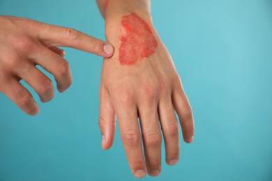 Photo of Man with burned hand on light blue background, closeup
