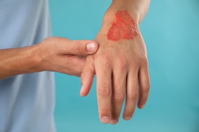 Photo of Man with burned hand on light blue background, closeup