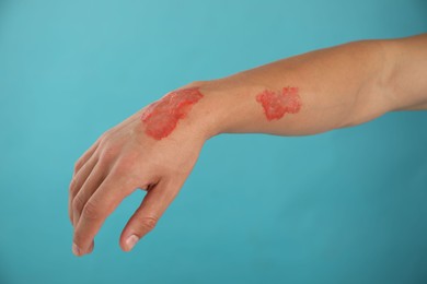 Photo of Man with burned hand on light blue background, closeup