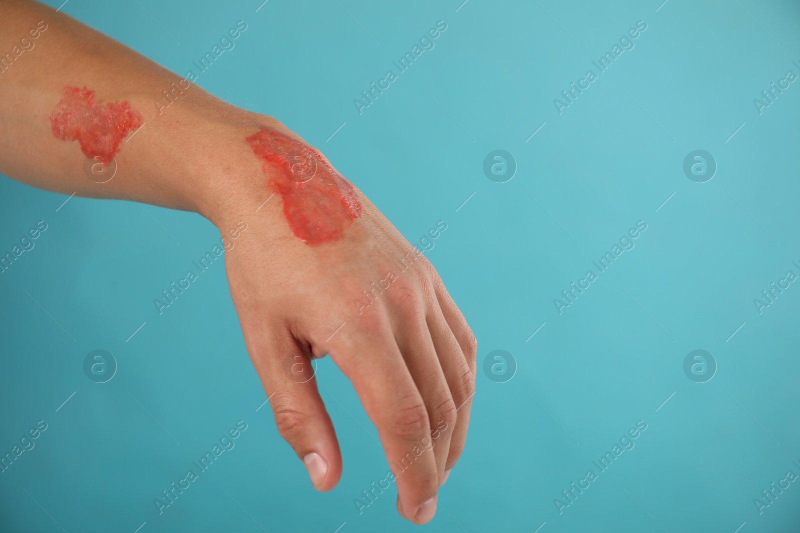 Photo of Man with burned hand on light blue background, closeup. Space for text
