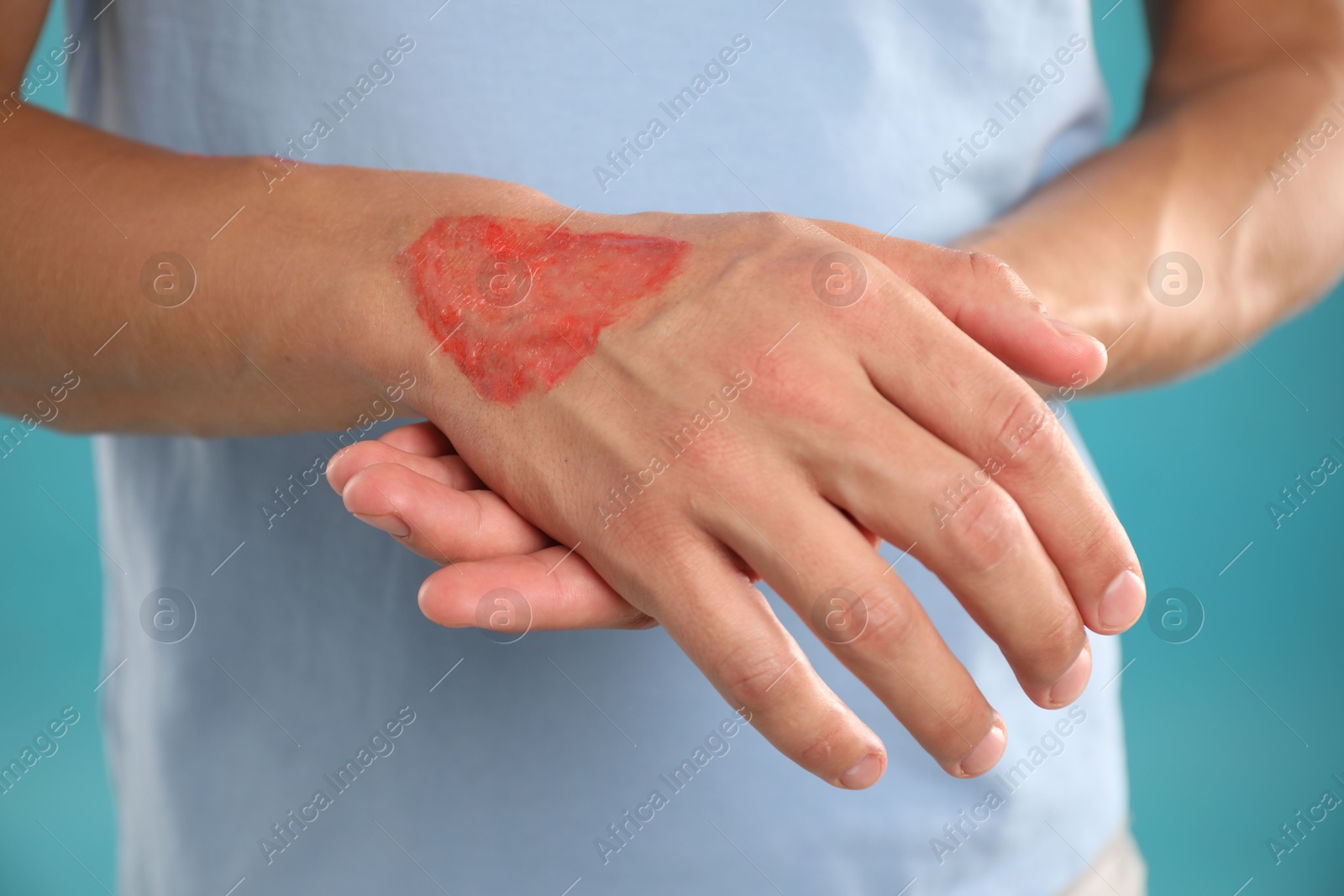 Man with burned hand on light blue background, closeup Photo of Man with burned hand on light blue background, closeup