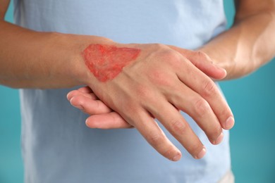 Photo of Man with burned hand on light blue background, closeup