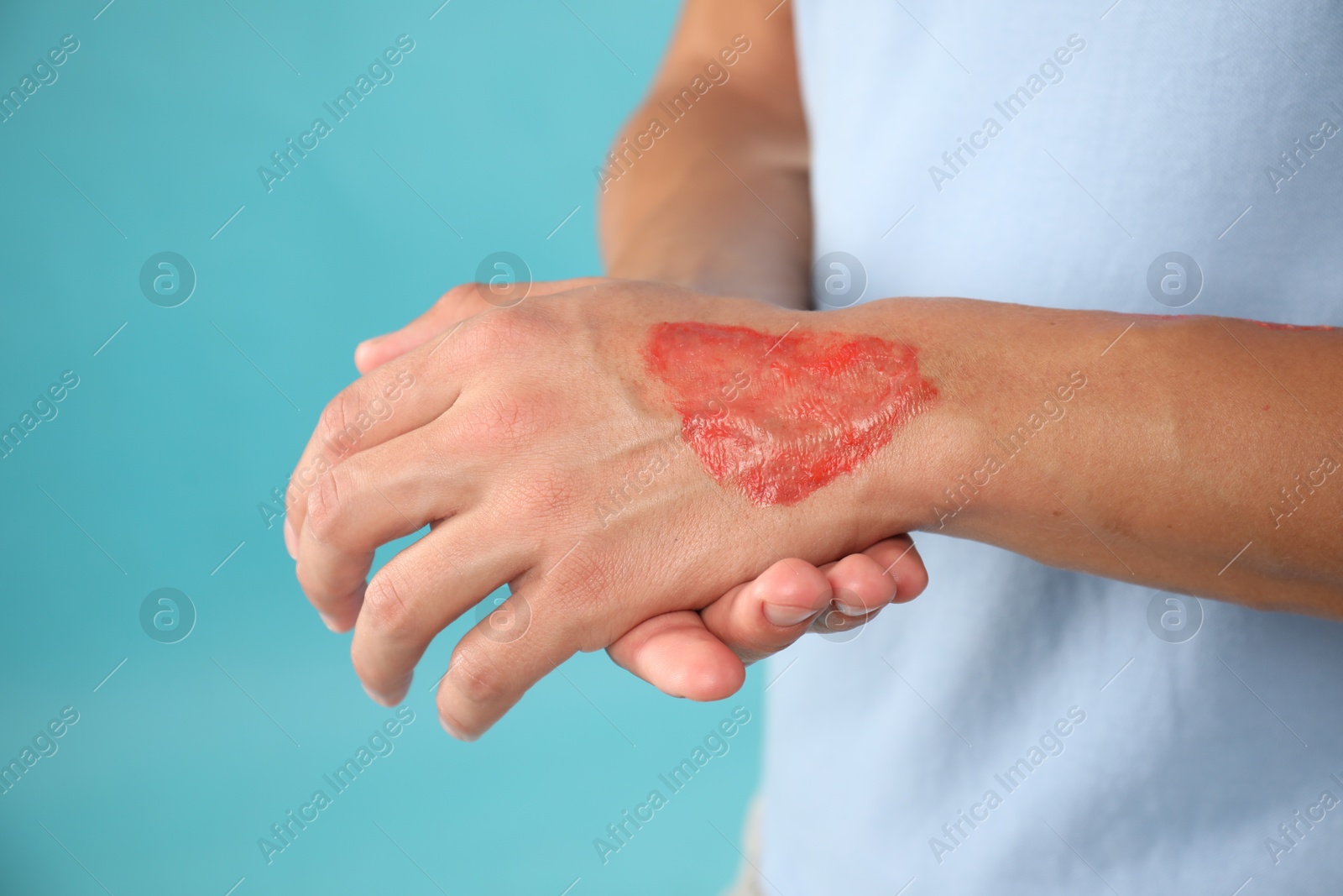 Man with burned hand on light blue background, closeup Photo of Man with burned hand on light blue background, closeup