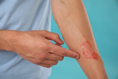Photo of Man with burned hand on light blue background, closeup
