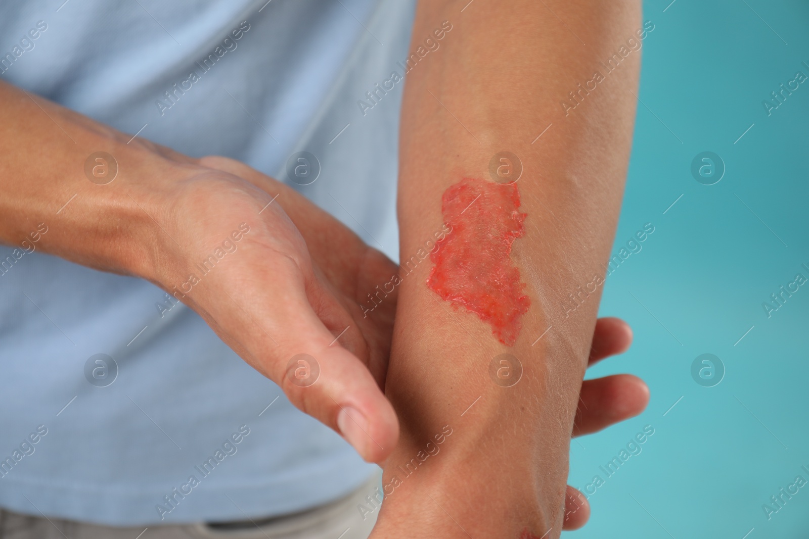 Man with burned hand on light blue background, closeup Photo of Man with burned hand on light blue background, closeup
