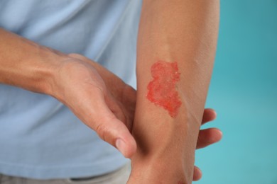 Photo of Man with burned hand on light blue background, closeup