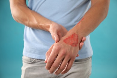 Photo of Man with burned hand on light blue background, closeup