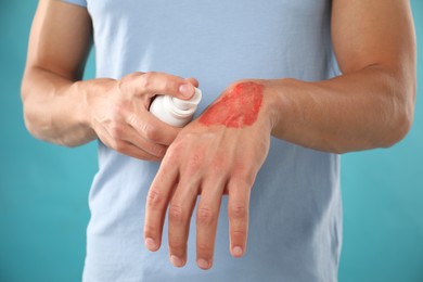 Photo of Man applying healing cream onto burned hand on light blue background, closeup
