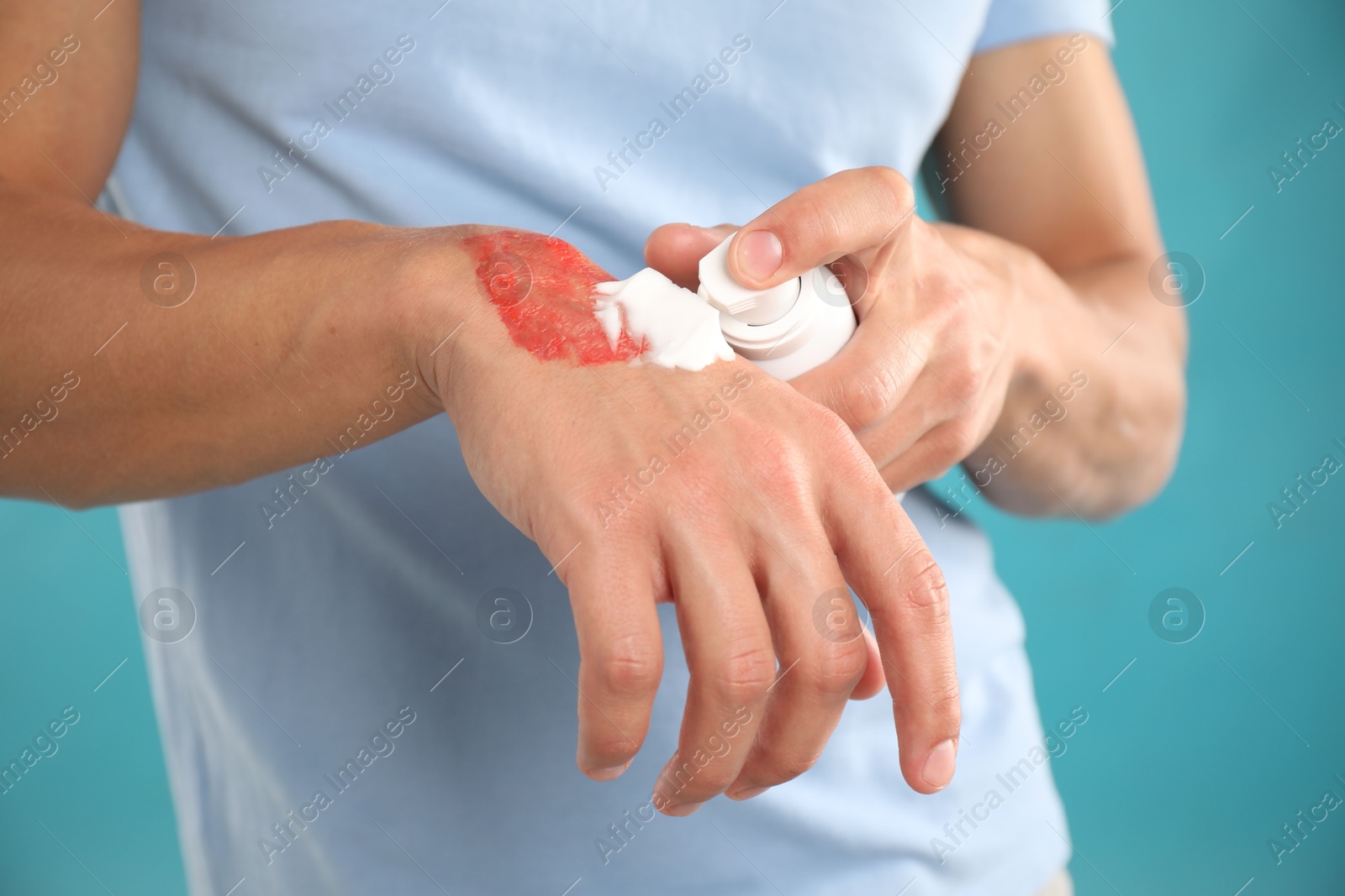 Man applying healing cream onto burned hand on light blue background, closeup Photo of Man applying healing cream onto burned hand on light blue background, closeup