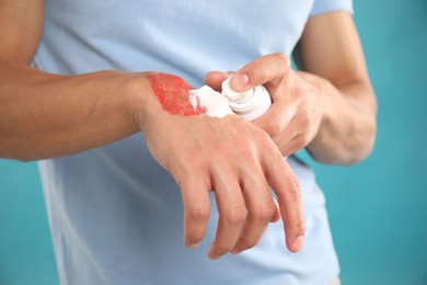 Photo of Man applying healing cream onto burned hand on light blue background, closeup