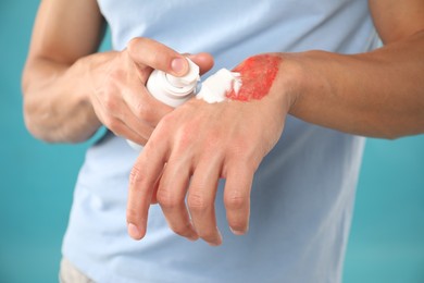 Photo of Man applying healing cream onto burned hand on light blue background, closeup