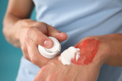 Photo of Man applying healing cream onto burned hand on light blue background, closeup