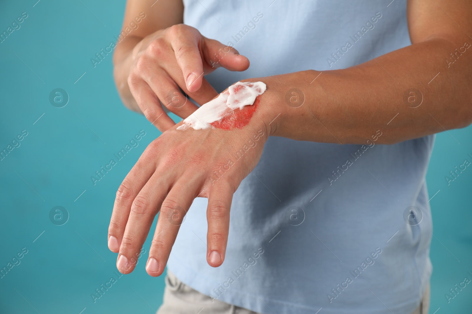 Man applying healing cream onto burned hand on light blue background, closeup Photo of Man applying healing cream onto burned hand on light blue background, closeup