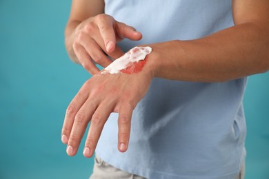 Photo of Man applying healing cream onto burned hand on light blue background, closeup