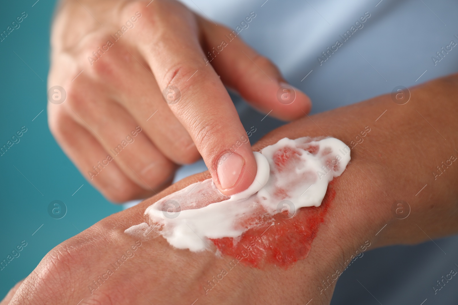 Man applying healing cream onto burned hand on light blue background, closeup Photo of Man applying healing cream onto burned hand on light blue background, closeup