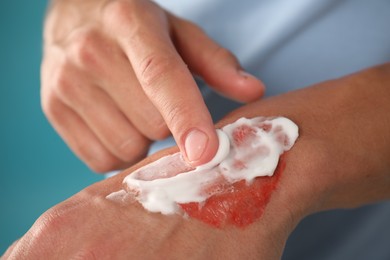 Photo of Man applying healing cream onto burned hand on light blue background, closeup